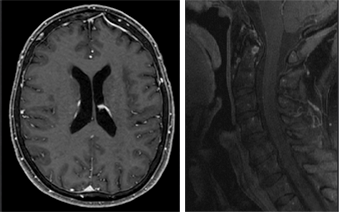 T1 with IV Gadolinium Contrast (T1-post)